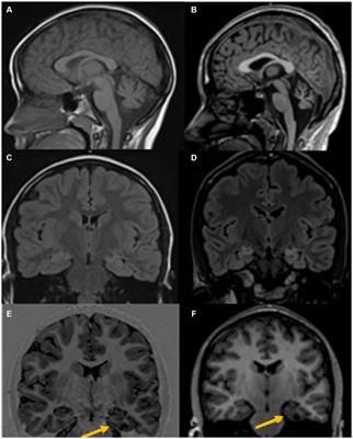 A not so incidental ‘incidentaloma’ − pediatric ganglioneuroma-associated cerebellar degeneration and super-refractory status epilepticus: case report and literature review